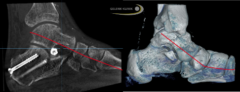 Spreizer (Prothese) im unteren Sprunggelenk