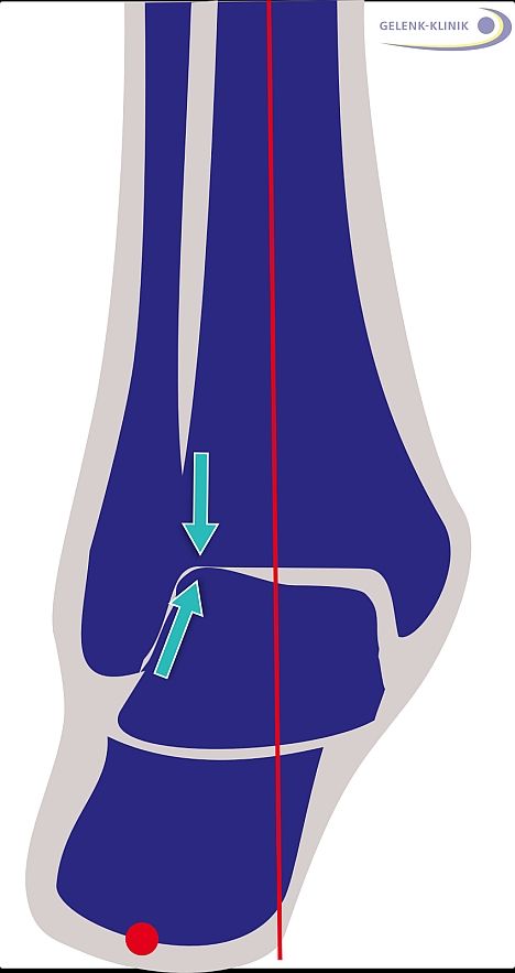 Fehlstellung des Fersenbeins von hinten