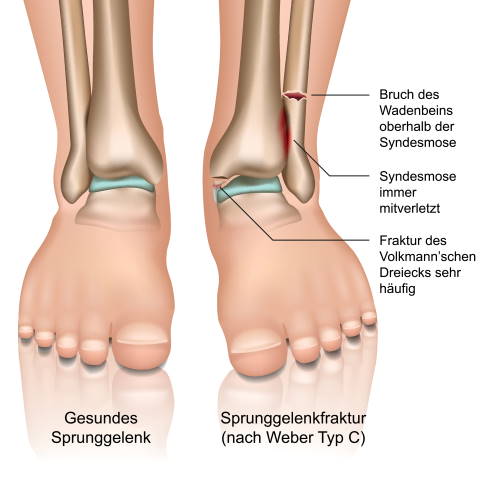 Wie bein lange gips gebrochen Unterarmbruch beim