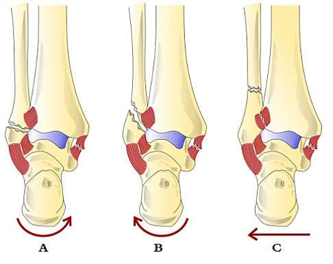 Klassifikation der Sprunggelenksbrüche nach Weber
