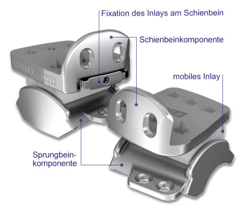 Sprunggelenksprothesen Abbildung