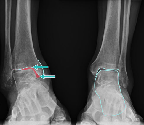 Behandlung von Varusarthrose