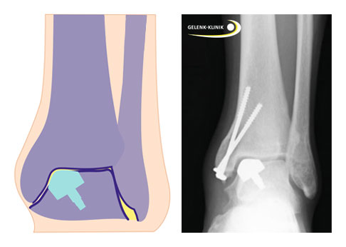 Implantation einer Teilprothese im Sprungbein über eine Osteotomie im Bereich des Innenknöchels.