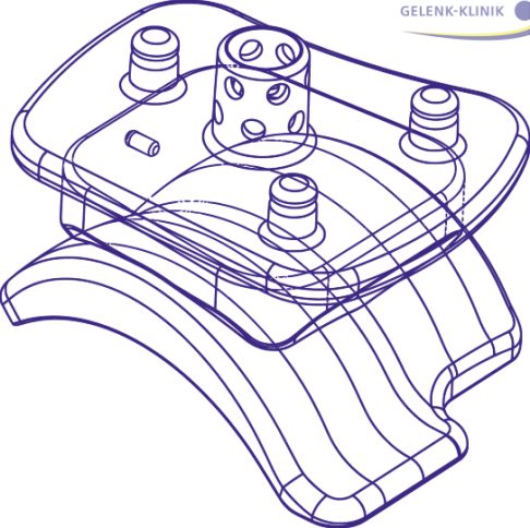 Die Konstruktionszeichnung zeigt den Aufbau einer Sprunggelenksprothese der 5. Generation. © Gelenk-Klinik