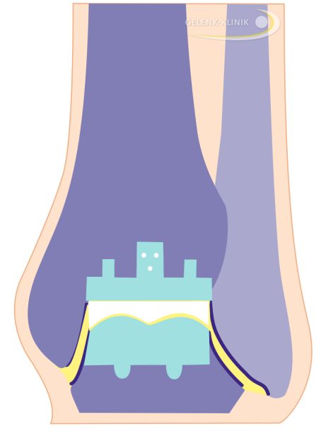 Schematische Zeichnung einer modernen Sprunggelenksprothese