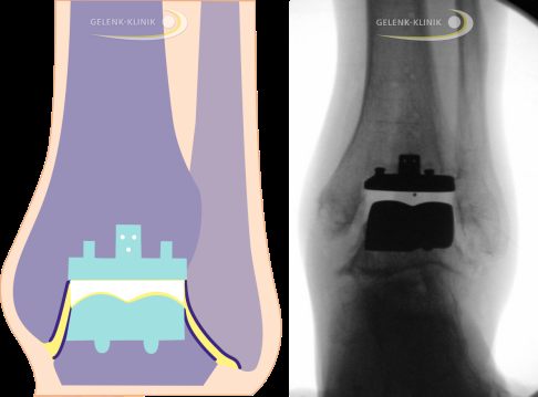 Schema und Röntgenkontrolle einer modernen Sprunggelenksprothese (OSG-TEP)