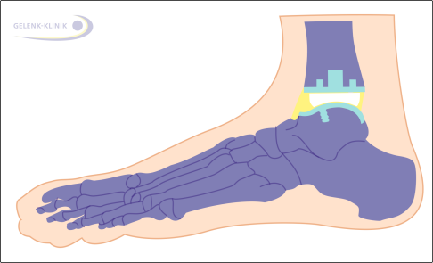 Schematische Abbildung einer Sprunggelenksprothese