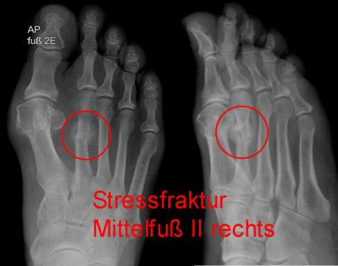 Röntgenbild eines Ermüdungsbruchs