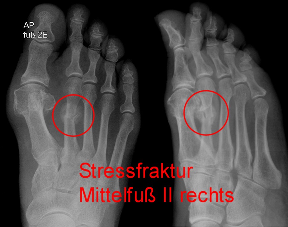 Stressfraktur des 2. Mittelfußknochens