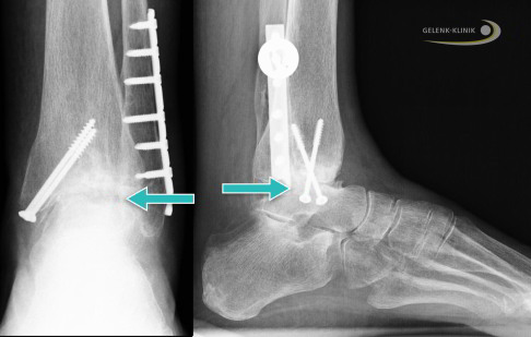 Röntgenbild einer stabilisierten Sprunggelenksfraktur mit Talusnekrose