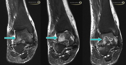 Talusnekrose mit Knochenödem im MRT-Bild