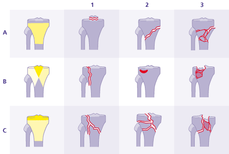 Schematische Übersicht: AO-Klassifikation Tibiakopfbrüche A, B, C.