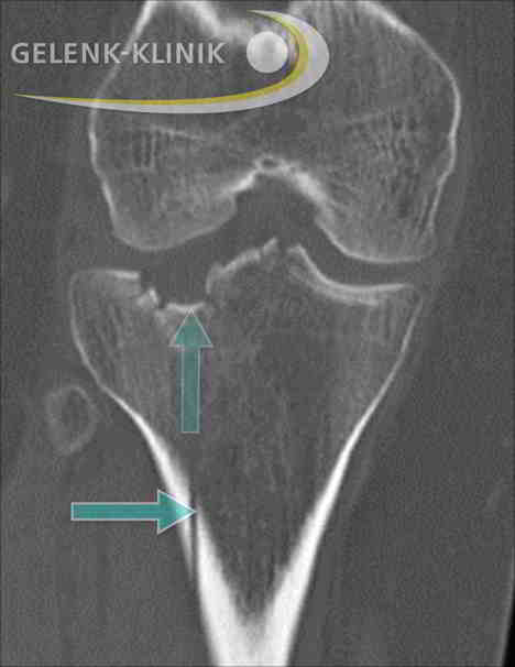 Röntgenbild einer Tibiakopffraktur