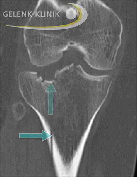 Tibiakopffraktur Bruch Des Schienbeinkopfes Gelenk Klinik De
