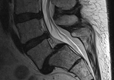 Liegt eine Spondylolisthesis vor, verschieben sich die Wirbelkörper gegeneinander. Eine Bandscheibenprothese hätte keinen Halt. © Gelenk-Klinik MRT einer Spondylolisthese (Wirbelgleiten)