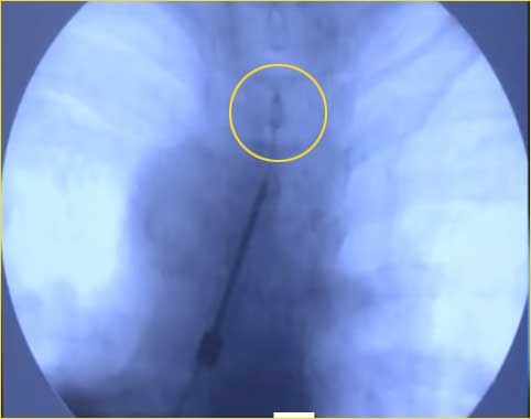 Innerhalb des Rückenmarks wird die PASHA-Elektrode (EPRF-Elektrode) mit Hilfe eines Röntgensichtgerätes an die schmerzauslösende Stelle navigiert. © omar-pasha.com 