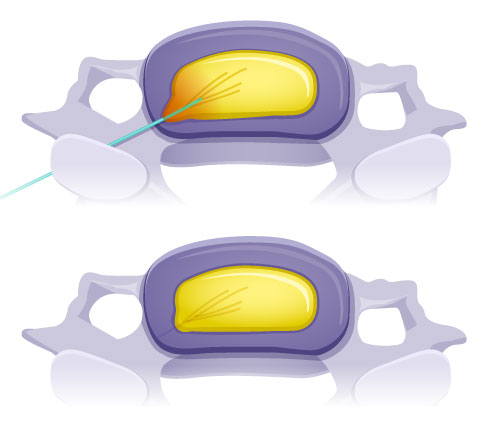 Lage der Elektrode bei Nukleoplastie