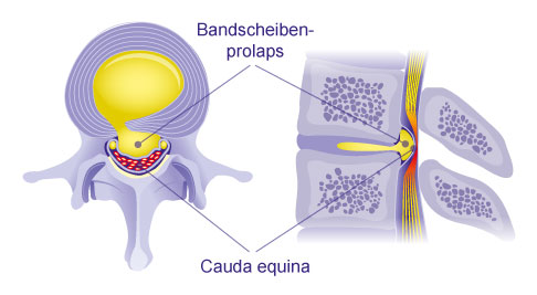 Bandscheibenprolaps Cauda equina