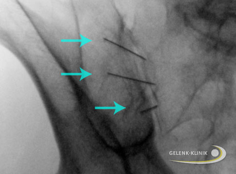 Infiltrationstherapie der Iliosakralgelenke