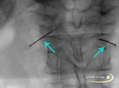 Infiltrationstherapie der Lendenwirbelsäule