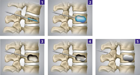 Ablauf der Kyphoplastie