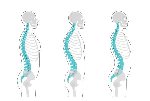 Vergleich normale Wirbelsäule, Kyphose, Lordose