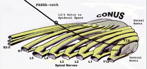 Изображение хода катетера PASHA по нервам заднего рога спинного мозга после его помещения на нервный корешок L3/L4. Нервные волокна заднего рога спинного мозга отвечают за переработку болевой сигнализации в центральной нервной системе. Во время данной процедуры можно провести лечение нескольких нервных корешков. © omar-pasha.com