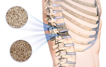 Sinterung eines der Wirbelkörpers aufgrund von Osteoporose