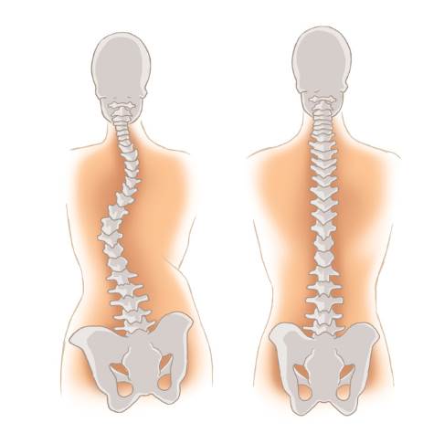 Слева: неправильное положение тазовых костей и следующее из этого сколиотическое положение позвоночника. Причиной может быть дисплазия. © Koterka Studio, Adobe Stock