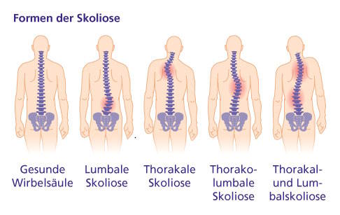 Formen der Skoliose