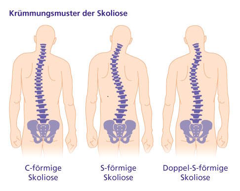 Skoliose: seitliche Fehlstellung der Wirbelsäule