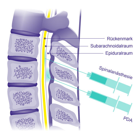 Prinzip der Spinalanästhesie im Vergleich zur PDA