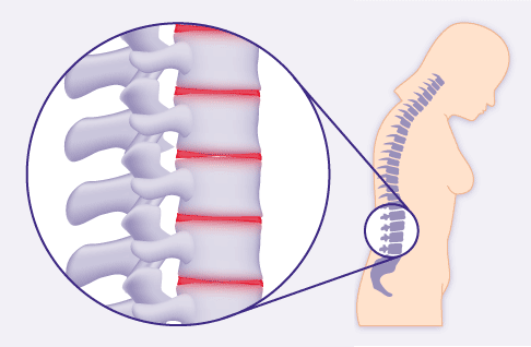 Versteifte Wirbelsäule bei Spondylitis ankylosans: Die Lendenwirbelsäule hat ihre Krümmung verloren.