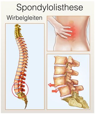 Eine Spondylolisthesis (Wirbelgleiten) entsteht häufig durch Verschleißprozesse in der Lendenwirbelsäule. Die Wirbelsäule wird instabil und Betroffene leiden unter starken Rückenschmerzen. Die Facettendenervierung ist eine Möglichkeit, diese Schmerzen zu lindern. © Henrie, Fotolia Spondylolisthese (Wirbelgleiten)