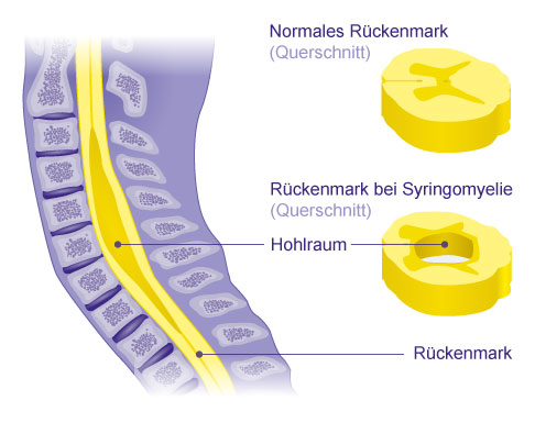 Vergleich: gesundes Rückenmark und Rückenmark mit Syringomyelie