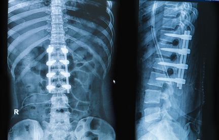 Bei einer Spondylodese (operative Versteifung) werden die betroffenen Wirbel mittels Schrauben verbunden und so wieder stabilisiert. Die Spondylodese wird insbesondere eingesetzt, wenn Gleitwirbel den Spinalkanal verengen. © praisaeng, Fotolia Röntgenbild: Versteifung der Lendenwirbelsäule